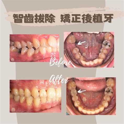 牙齒歪斜|前牙矯正怎麼做？完整認識歪斜類型及解方，用隱形牙。